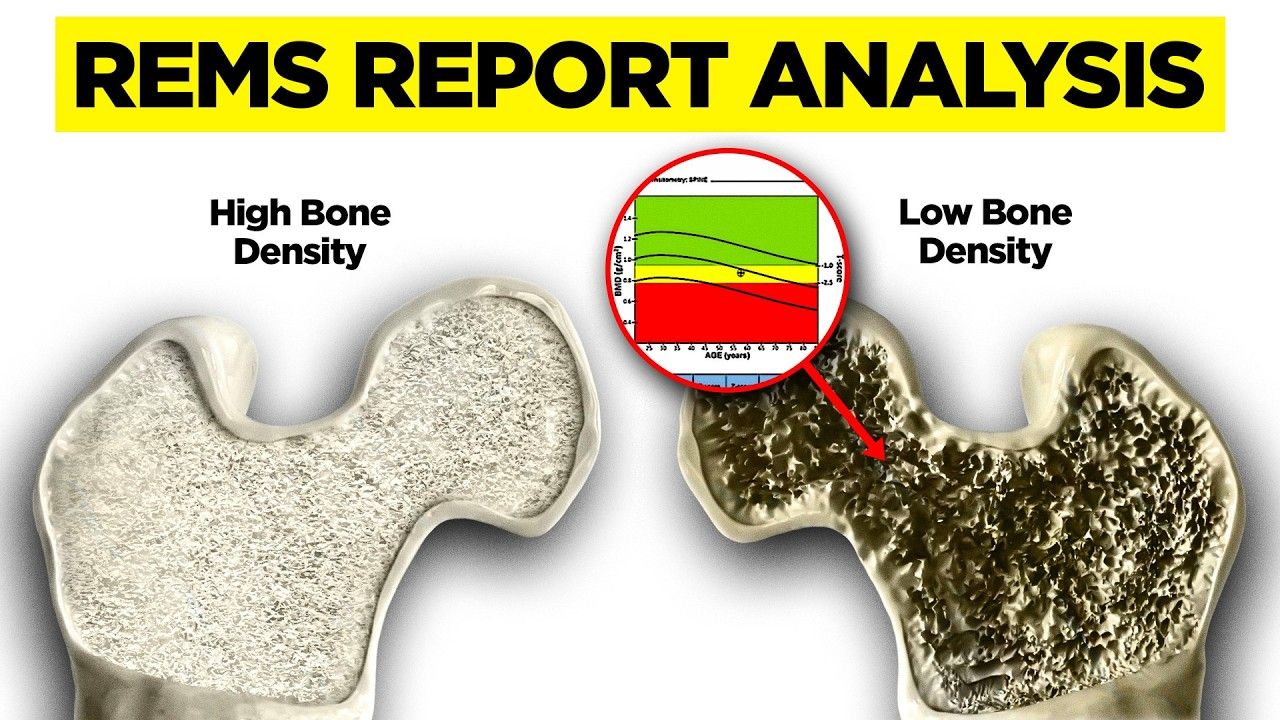 REMS ultrasound bone density scan
