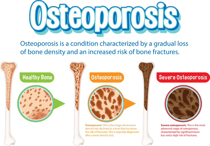 Bone health and osteoporosis